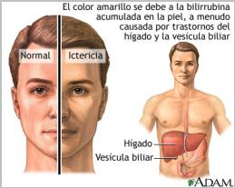 Imatge 20: La icterícia. www.nlm.nih.gov